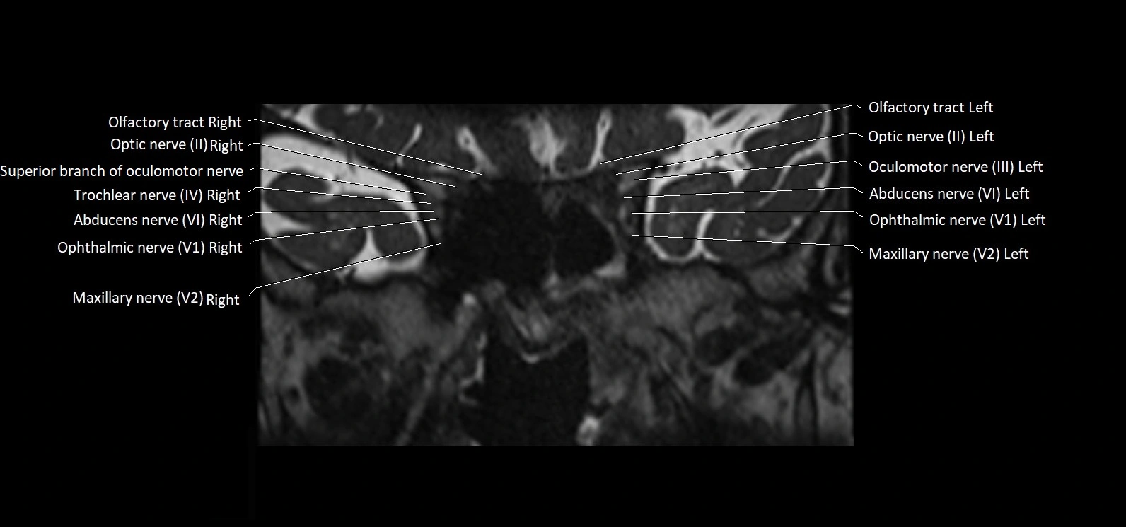 Cranial nerve cross sectional anatomy coronal 3T MRI image 19.webp